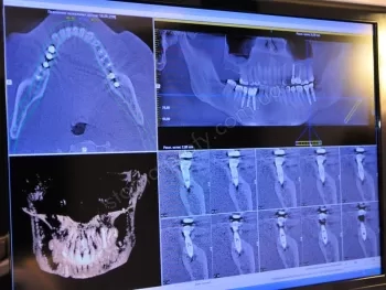 Implantacja dentystyczna