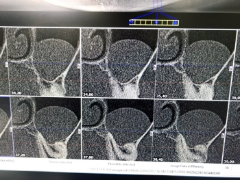 Комп'ютерна томографія риногенної кісти. 
